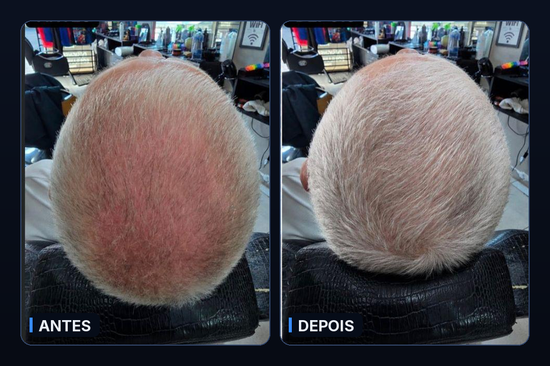 Antes e depois do protocolo Fio Derma