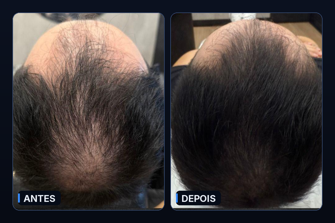 Antes e depois do protocolo Fio Derma